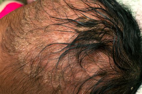 cradle cap in adults nhs.
